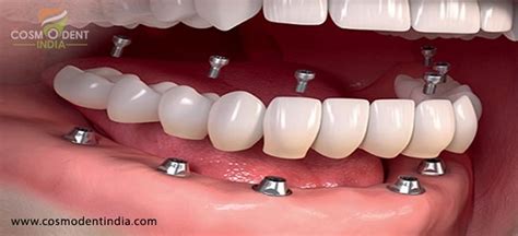 Full Dental Implants Cost In India Dental Implants In India Best