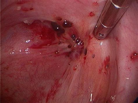 PATHOPHYSIOLOGY AND CLINICAL PRESENTATION OF CORRECT DIAGNOSIS | Endometriosis Case Study