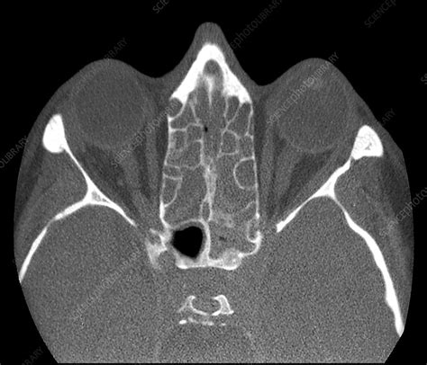 Ethmoid Sinus Infection Ct Scan Stock Image C0469126 Science