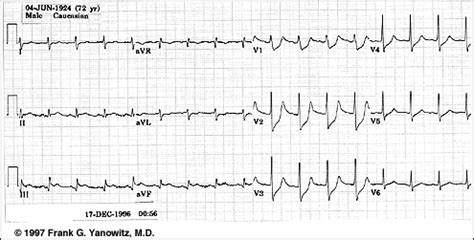 Depresi (kinesiologi), salah satu gerakan anatomi, depresi (ekonomi), keadaan perniagaan yang sukar dan lesu, depresi (geologi). emergency case: Segmen ST pada penyakit jantung