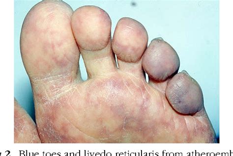 Figure 2 From Blue Toe Syndrome From Decreased Arterial Perfusion