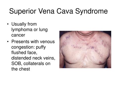 How Is Svc Syndrome Diagnosed Mastery Wiki