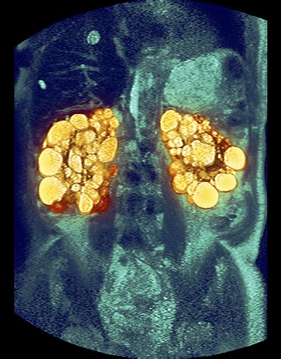 How did i miss it? Adult polycystic kidney disease management - Clinical Advisor