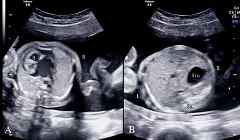 Comparing Levocardia And Dextrocardia In Fetuses With Heterotaxy