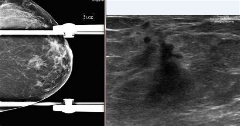 The Mammogram Demonstrates Several Spiculated Masses On Ultrasound