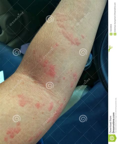 Allergic Dermatitis Allergic Food Allergic Skin Rash Allergic