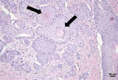 Histopathological Examination Of Squamous Cell Carcinoma Prior To