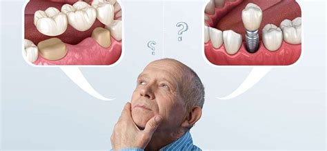 Tooth Replacement Options Compared Dental Bridge Vs Implant