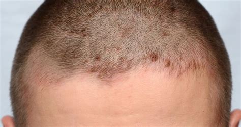 56 Best Of Rash On Head After Haircut Haircut Trends
