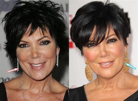 Kris Jenner Before And After Plastic Surgery Pics