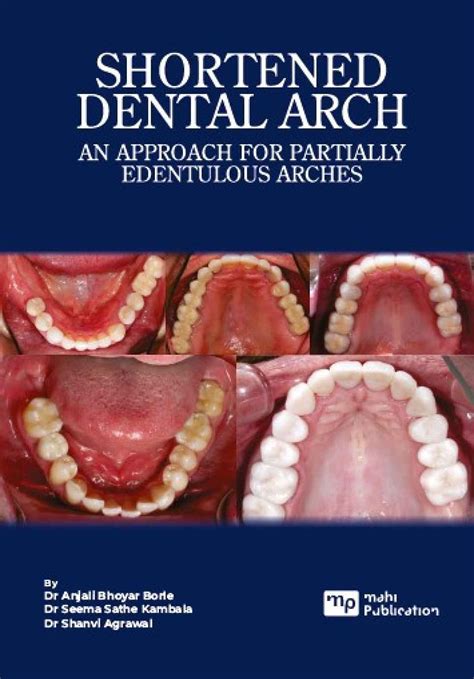 Shortened Dental Arch An Approach For Partially Edentulous Arches Dr