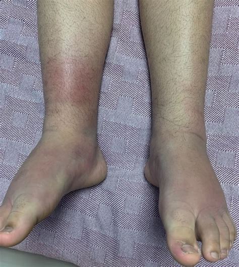 Bilateral Leg Swelling As The Presenting Symptom Of Löfgren Syndrome In