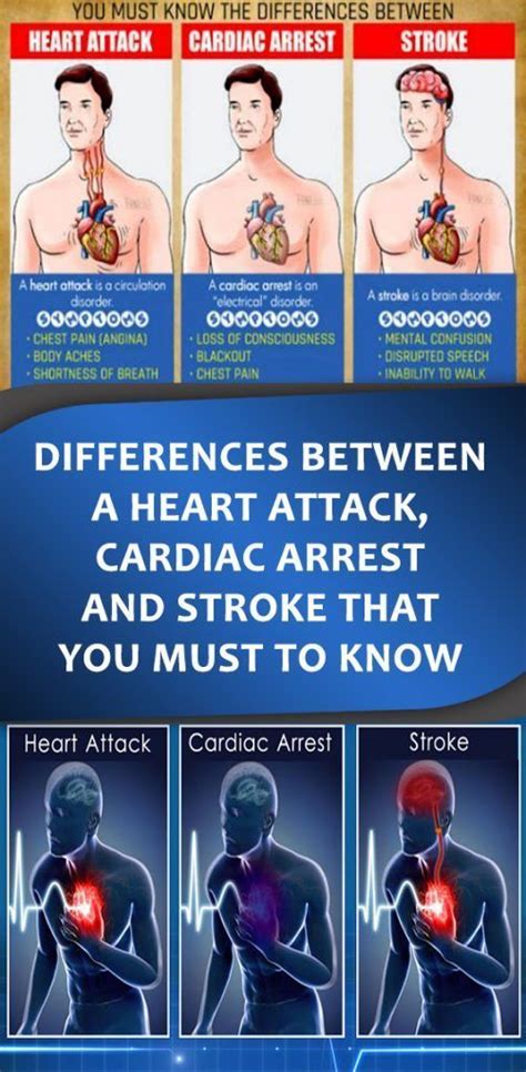 Differences Between A Heart Attack Cardiac Arrest And Stroke That You