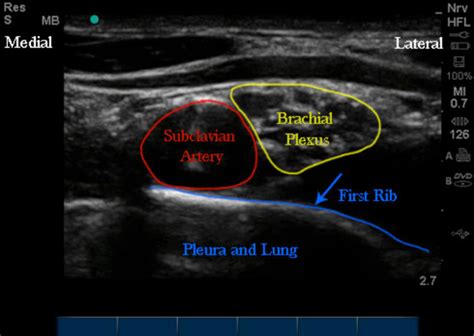 Ultrasound Anatomy Supraclav Block Openanesthesia