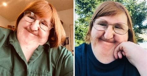 A Criticized Woman With Rare Bone Disease Shares A Selfie A Day And