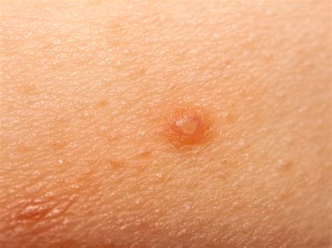 Tiny Red Bumps On Skin Itchy Jameslemingthon Blog