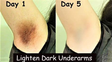 Lighten Dark Underarms In 5 Days Dark Underarms Whitening Turmeric