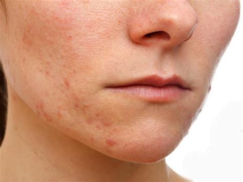 11 Must Know Amazing Home Remedies For Eczema On Face