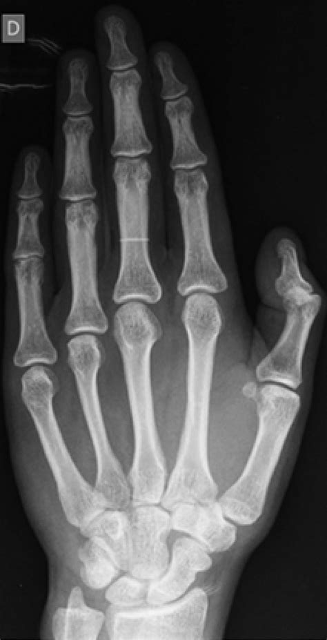 Right Hand Anteroposterior Radiograph Of The Normal Patient Download Scientific Diagram