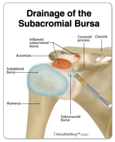 The shoulder is comprised of a ball (humerus) and socket (scapula), bones, ligaments, tendons and muscles that move the arms and connect them to the torso. 28 best Bursitis of the Hip, Knee, Shoulder, and Elbow images on Pinterest | Bursa, Exercises ...