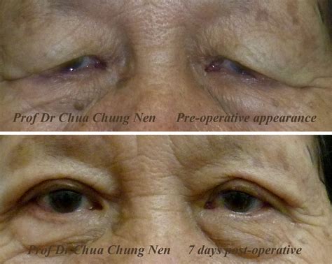 Eyelid Surgery By Prof Dr Cn Chua Double Eyelid For An Year Old