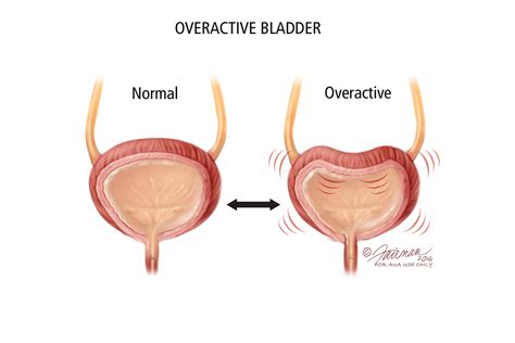 What Are The Causes Of Oab Urology Care Foundation