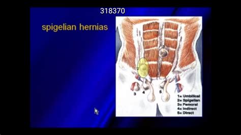 Ultrasound Of Hernias Ultrasonido Hernia