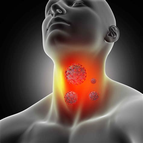 Sore Throatpharyngitis Symptoms Causes Diagnosis And Treatment