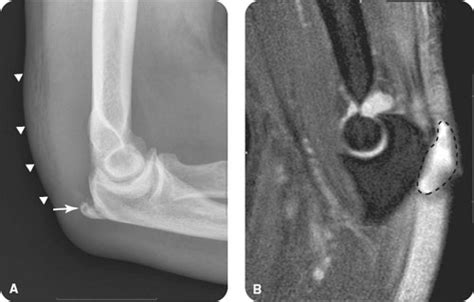 Olecranon Fractures Radiology Key