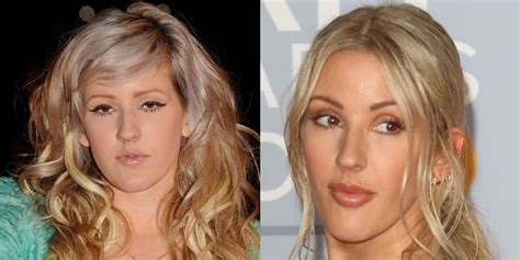 Why Ellie Goulding Is Petrified Of Plastic Surgery Face Before And After