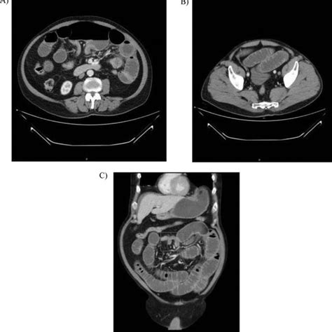 A B And C A Post Iv Contrast Ct Abdomen And Pelvis Demonstrating