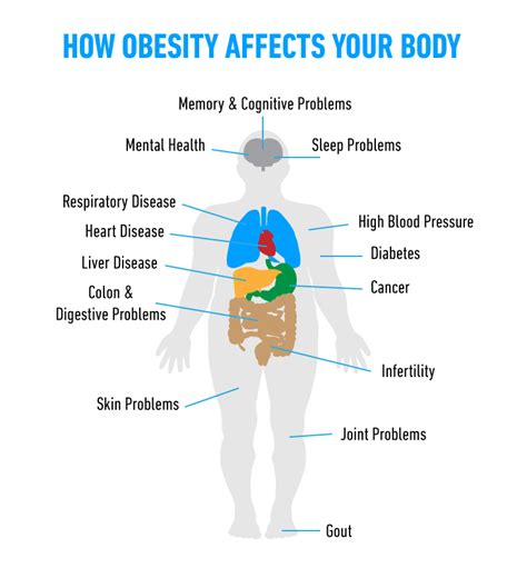How Obesity Affects Your Body In Mexico S Best Private Hospitals
