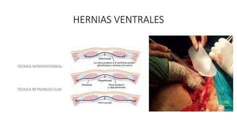 Hernias De Pared Anterolateral De Abdomen Y Lumbar
