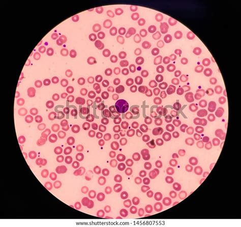 Basophil Peripheral Blood Smear Stock Photo 1456807553 Shutterstock