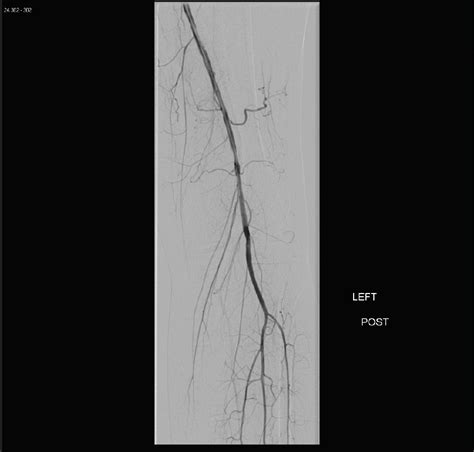 Endovascular Today Sex Related Differences In Lower Extremity Peripheral Artery Disease