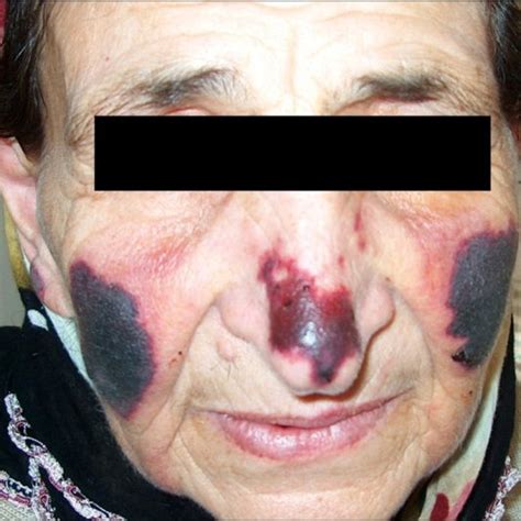 Rash After Using Amoxicilline In Patient With Infectious Mononucleosis