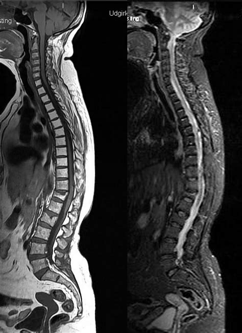 The Spinal Cord Mri Of The Spinal Cord