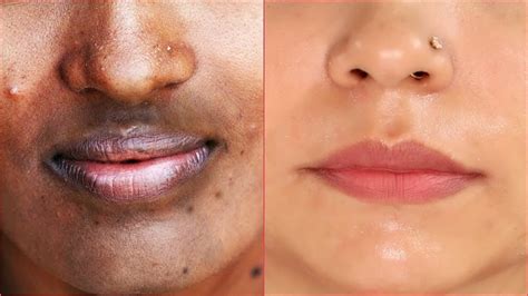 How To Remove Black Spots Near Lips