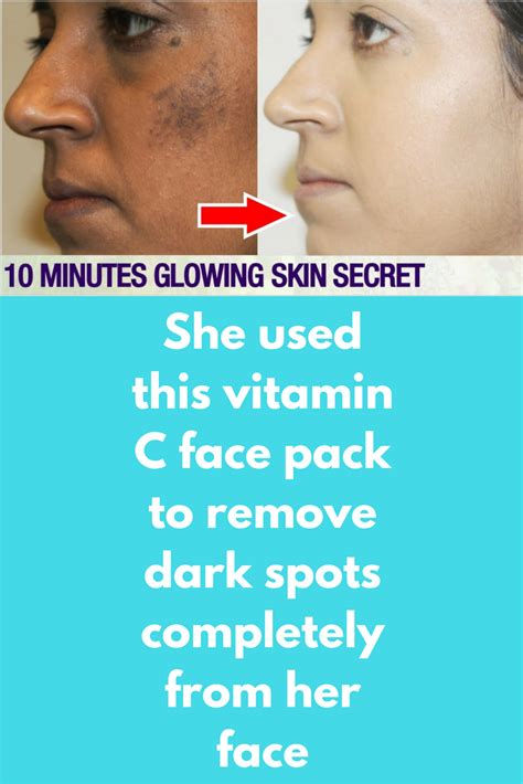 She Used This Vitamin C Face Pack To Remove Dark Spots Completely From