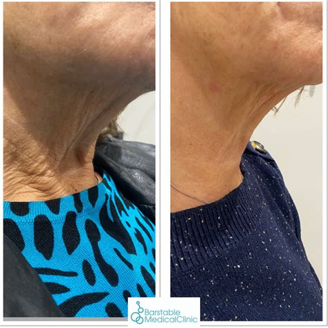 Nefertiti Neck Lift Essex Barstable Medical Clinic