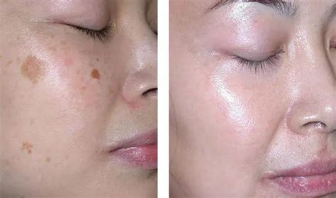 How To Get Rid Of Age Spots On Facehands And Legs Fast Naturally