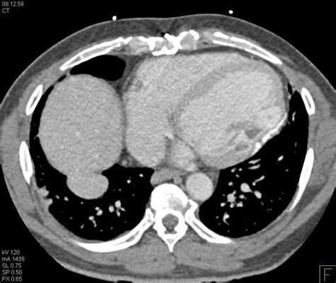 Infarct With Calcification Left Ventricle Wall Cardiac Case Studies