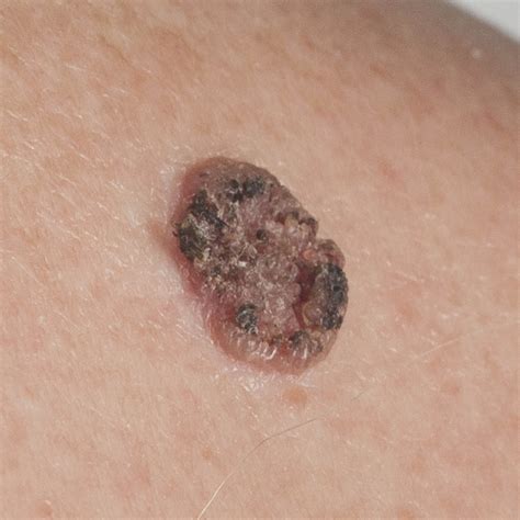 Squamous Cell Carcinoma Skin Cancer Surgery