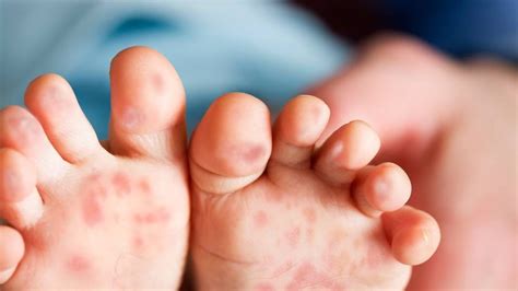Protecting Loved Ones From Hand Foot And Mouth Disease Getdoc Says