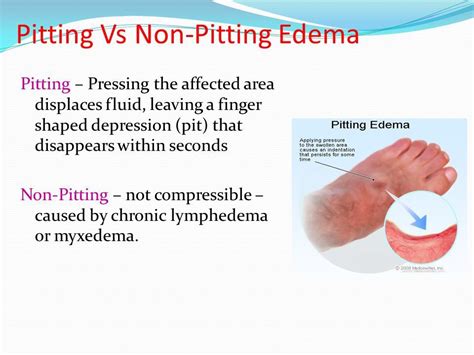 Pitting Vs Non Pitting Edema Kennethmcywise