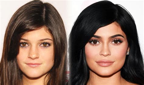 Kylie Jenner Veneers Before And After