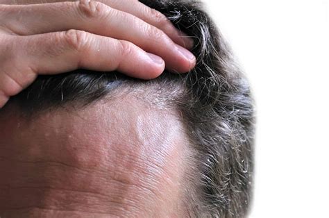 How To Get Rid Of Dandruff And Itchy Scalp