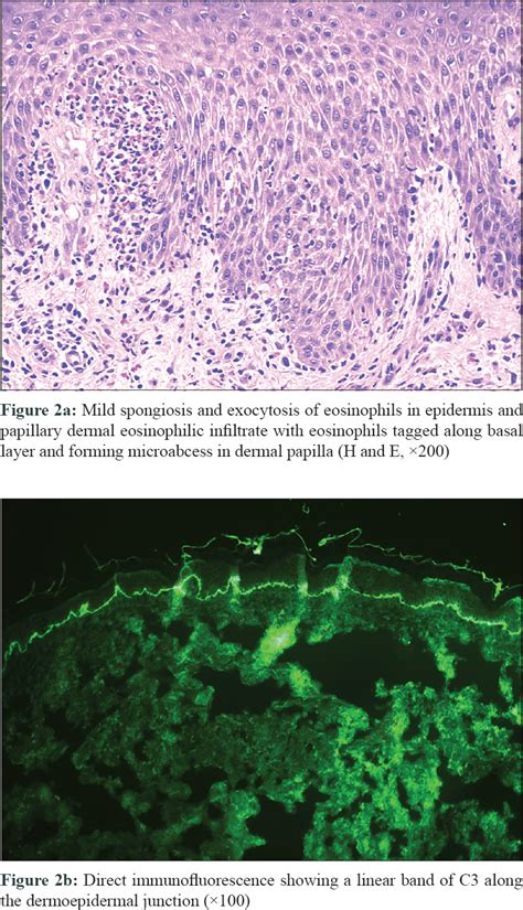 Skin Biopsy Induced Blistering In Urticarial Bullous Pemphigoid Indian Journal Of Dermatology