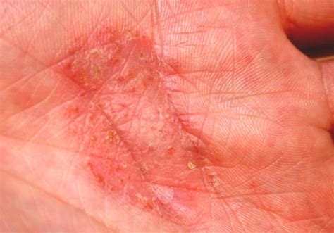 Hand Eczema Eczema On Hands Cure