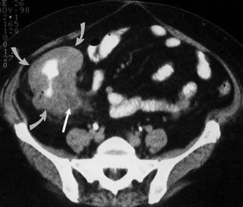 Spiral Ct Of Colon Cancer Imaging Features And Role In Management